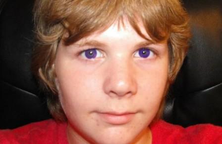 Александрийский синдром, редкий фиолетовый цвет глаз